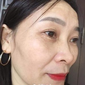 Sau khi dùng kem nám Huyền Phi giảm tới 95% Nám